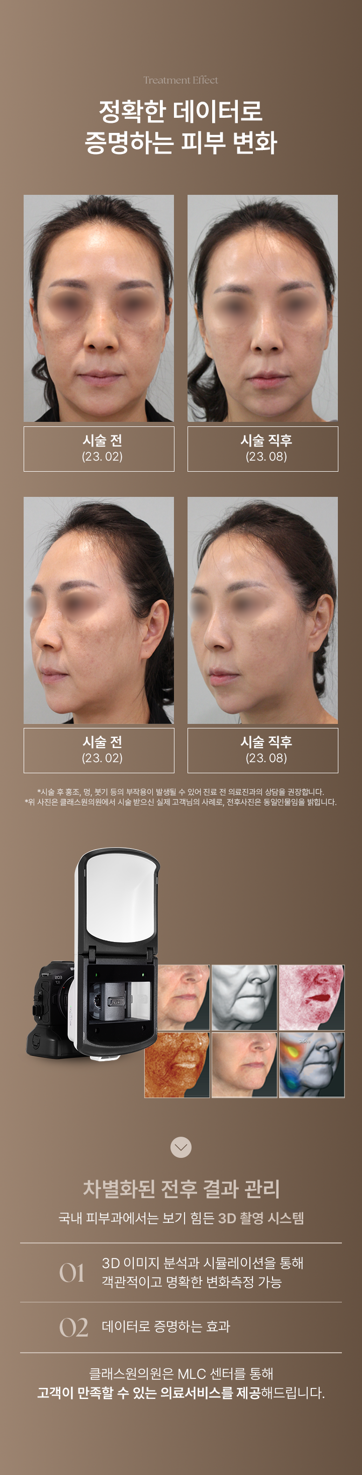 Treatment Effect. 정확한 데이터로 증명하는 피부 변화. 시술전후 첫번째 케이스는 시술 전(23.02), 시술직후(23.08) 비교 이미지 입니다. 시술전후 두번째 케이스는 시술 전(23.02), 시술직후(23.08) 비교 이미지 입니다. *시술 후 홍조,멍,붓기 등의 부작용이 발생될 수 있어 진료 전 의료진과의 상담을 권장합니다. *위 사진은 클래스원의원에서 시술 받으신 실제 고객님의 사례로, 전후사진은 동일인물임을 밝힙니다. 차별화된 전후 결과 관리. 국내 피부과에서는 보기 힘든 3D 촬영 시스템. 01) 3D 이미지 분석과 시뮬레이션을 통해 객관적이고 명확한 변화측정 가능. 02) 데이터로 증명하는 효과. 클래스원의원은 MLC 센터를 통해 고객이 만족할 수 있는 의료서비스를 제공해드립니다.