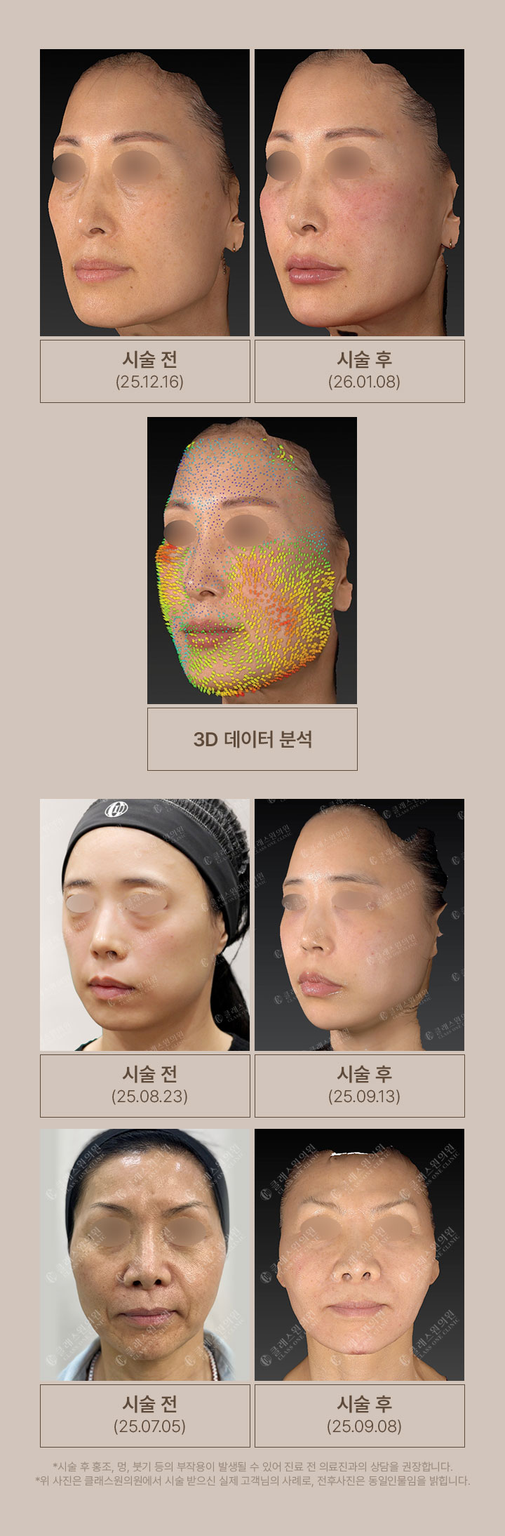 클래스원의원 Crêpe 시술 전후 비교 사례 3건. 첫 번째 사례는 시술 전(25.12.16), 시술 후(26.01.08) 측면 얼굴 사진과 3D 데이터 분석 이미지, 두 번째 사례는 시술 전(25.08.23)과 시술 후(25.09.13), 세 번째 사례는 시술 전(25.07.05)과 시술 후(25.09.08) 사진. 시술 후 홍조, 멍, 붓기 등의 부작용이 발생할 수 있어 진료 전 의료진과의 상담을 권장하며, 사진은 실제 고객 사례로 전후 동일인물임. *시술 후 홍조, 멍, 붓기 등의 부작용이 발생할 수 있어 진료 전 의료진과의 상담을 권장합니다. *위 사진은 클래스원의원에서 시술 받으신 실제 고객님의 사례로, 전후사진은 동일인물임을 밝힙니다.