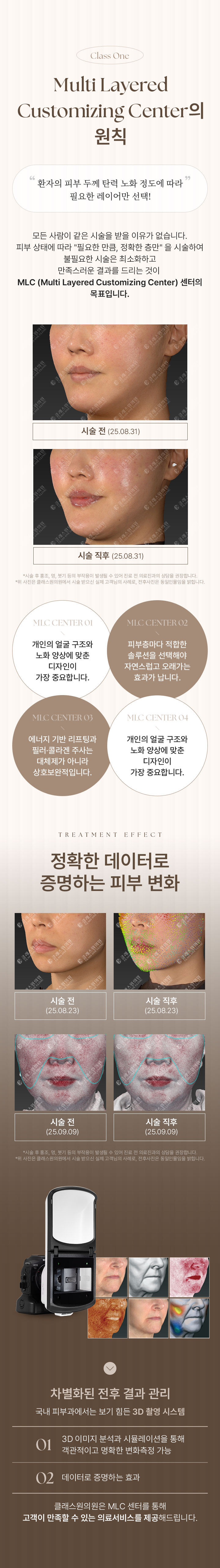 Class One. Multi Layered Customizing Center의 원칙. “환자의 피부 두께 탄력 노화 정도에 따라 필요한 레이어만 선택!” 모든 사람이 같은 시술을 받을 이유가 없습니다. 피부 상태에 따라 “필요한 만큼, 정확한 층만” 을 시술하여 불피요한 시술은 최소화하고 만족스러운 결과를 드리는 것이 MLC (Multi Layered Customizing Center) 센터의 목표 입니다. 시술 케이스는 시술 전(25.08.31), 시술직후 (25.08.31) 비교 이미지 입니다. *시술 후 홍조, 멍, 붓기 등의 부작용이 발생할 수 있어 진료 전 의료진과의 상담을 권장합니다. *위 사진은 클래스원의원에서 시술 받으신 실제 고객님의 사례로, 전후사진은 동일인물임을 밝힙니다. MLC Center 01:개인의 얼굴 구조와 노화 양상에 맞춘 디자인이 가장 중요합니다. MLC Center 02:피부층마다 적합한 솔루션을 선택해야 오래가는 효과가 나타납니다. MLC Center 03:에너지 기반 리프팅과 필러·콜라겐 주사는 대체제가 아니라 상호보완적입니다. MLC Center 04:정품·정량,표준화된 프로토콜이 예층 가능한 결과를 만듭니다. TREATMENT EFFECT 정확한 데이터로 증명하는 피부 변화. 시술 케이스 중 첫번째는 시술 전(25.08.23), 시술직후 (25.08.23) 비교 이미지 입니다. 시술 케이스 중 두번째는 시술 전(25.09.09), 시술직후 (25.09.09) 비교 이미지 입니다. *시술 후 홍조, 멍, 붓기 등의 부작용이 발생할 수 있어 진료 전 의료진과의 상담을 권장합니다. *위 사진은 클래스원의원에서 시술 받으신 실제 고객님의 사례로, 전후사진은 동일인물임을 밝힙니다. 차별화된 전후 결과 관리. 국내 피부과에서는 보기 힘든 3D 촬영 시스템. 01) 3D 이미지 분석과 시뮬레이션을 통해 객관적이고 명확한 변화측정 가능. 02) 데이터로 증명하는 효과. 클래스원의원은 MLC 센터를 통해 고객이 만족할 수 있는 의료서비스를 제공해드립니다.